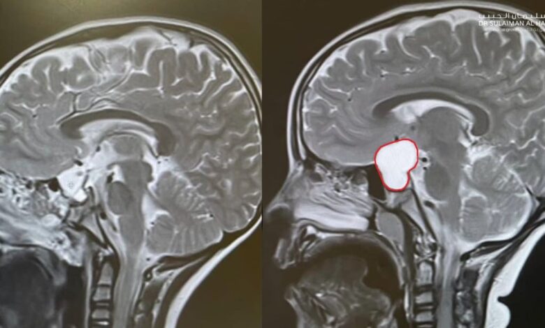 مستشفى الدكتور سليمان الحبيب بالخُبر ينقذ طفلًا من تَبِعات ورم كبير بالدماغ سبّب له صداعًا مستمرًّا وضعفًا شديدًا في النظر
