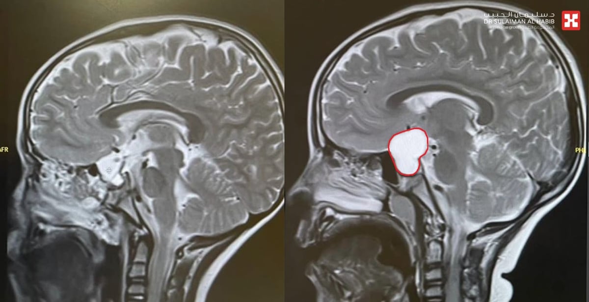 مستشفى الدكتور سليمان الحبيب بالخُبر ينقذ طفلًا من تَبِعات ورم كبير بالدماغ سبّب له صداعًا مستمرًّا وضعفًا شديدًا في النظر