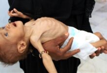 اليونيسف تطلق مبادرة تغذوية لتسريع الحد من نقص التغذية في اليمن