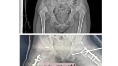حضرموت .. رغم شحة الإمكانيات نجاح عميلة نوعية بمستشفى الشحر العام