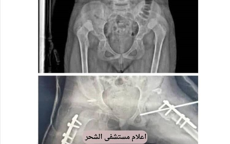 حضرموت .. رغم شحة الإمكانيات نجاح عميلة نوعية بمستشفى الشحر العام