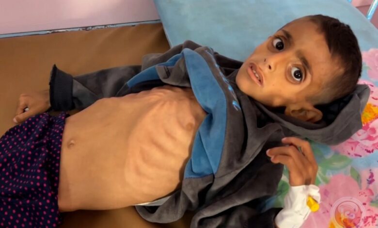 أكثر من 100 شخص ماتوا بسبب الجوع في غزة