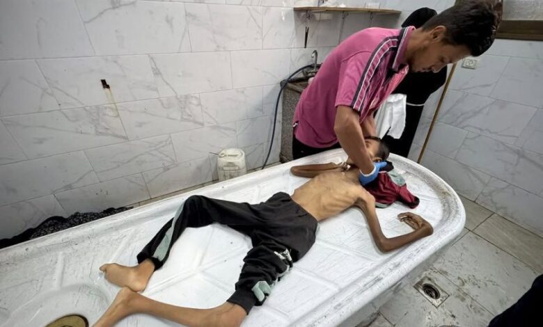 وفاة 10 أشخاص بسبب المجاعة وسوء التغذية في قطاع غزة