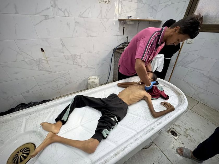 وفاة 10 أشخاص بسبب المجاعة وسوء التغذية في قطاع غزة