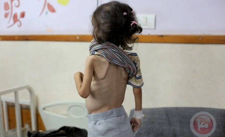 استشهاد طفلة جديدة بسبب الجوع في غزة