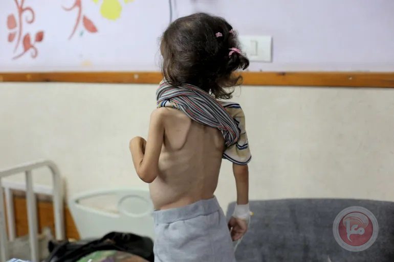 استشهاد طفلة جديدة بسبب الجوع في غزة
