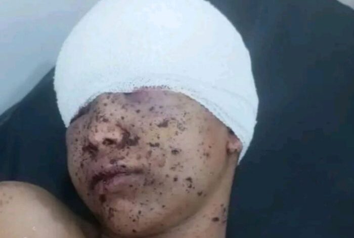 إصابة طفل بشظية قذيفة أطلقتها مليشيا الحوثي شمالي مدينة تعز