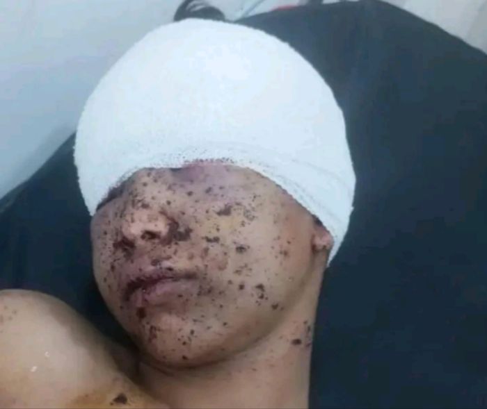 إصابة طفل بشظية قذيفة أطلقتها مليشيا الحوثي شمالي مدينة تعز