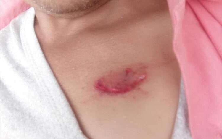 كلاب مسعورة تهاجم مواطنين في تورصة بالضالع وتصيب اثنين بجروح خطيرة