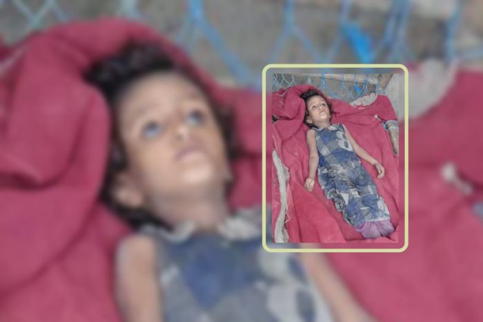 الجوع يفتك بطفلة نازحة في حجة في ظل نهب الحوثيين للمساعدات