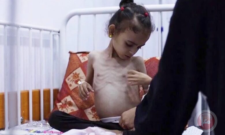 خمسة ضحايا جدد نتيجة الجوع في قطاع غزة يرفع الحصيلة إلى 162