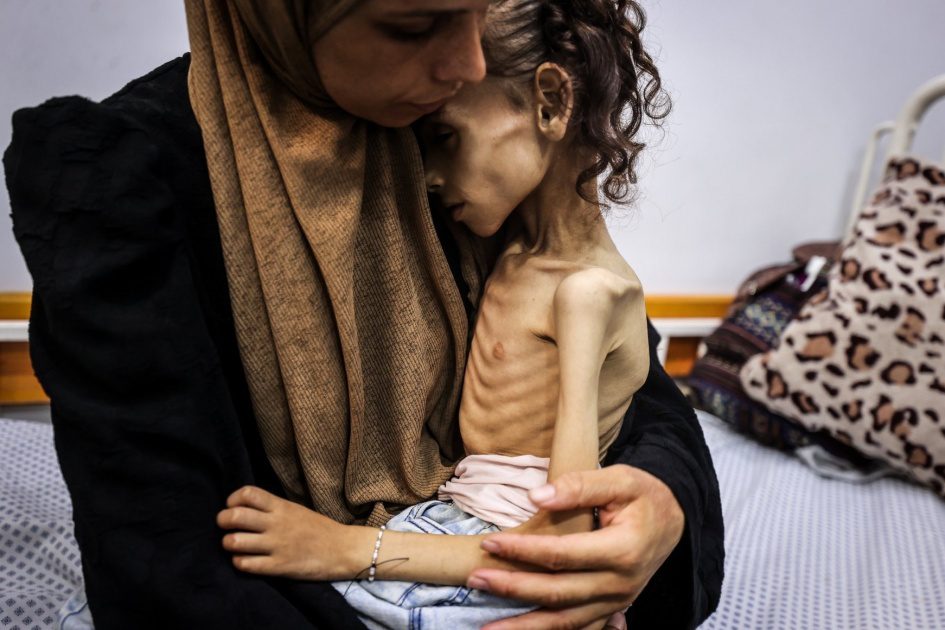 5 حالات وفاة جديدة نتيجة المجاعة وسوء التغذية في قطاع غزة