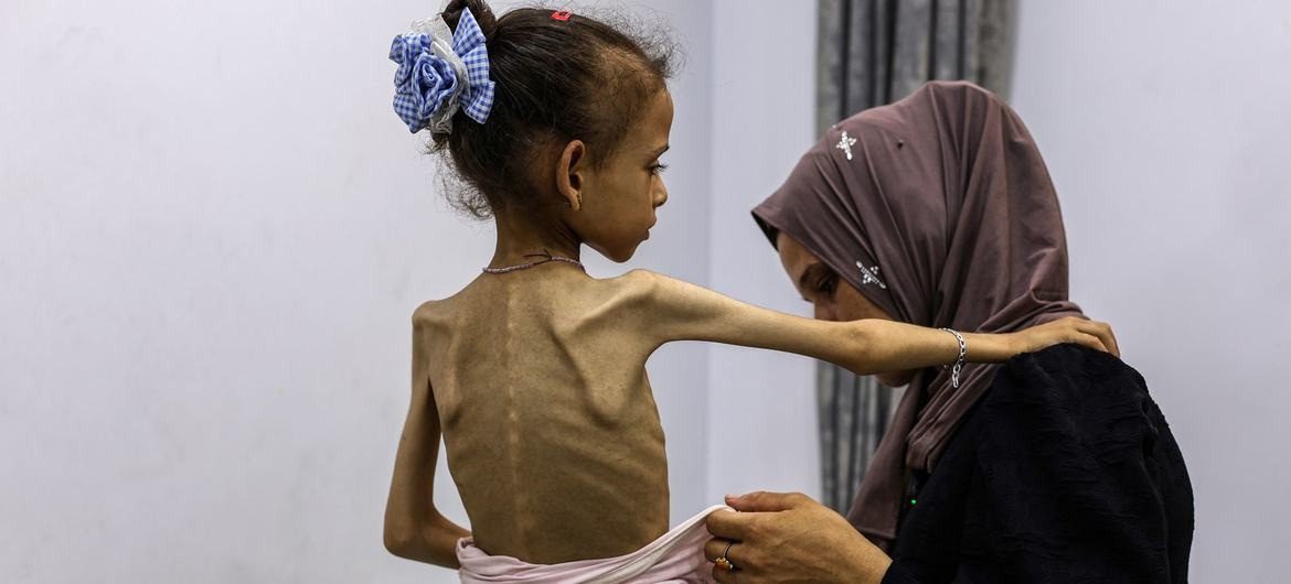 وفاة طفل في قطاع غزة نتيجة المجاعة وسوء التغذية