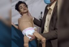 طفل يواجه الموت جوعًا في حجة.. مشهد جديد يلخص الكارثة الإنسانية التي صنعتها مليشيا الحوثي