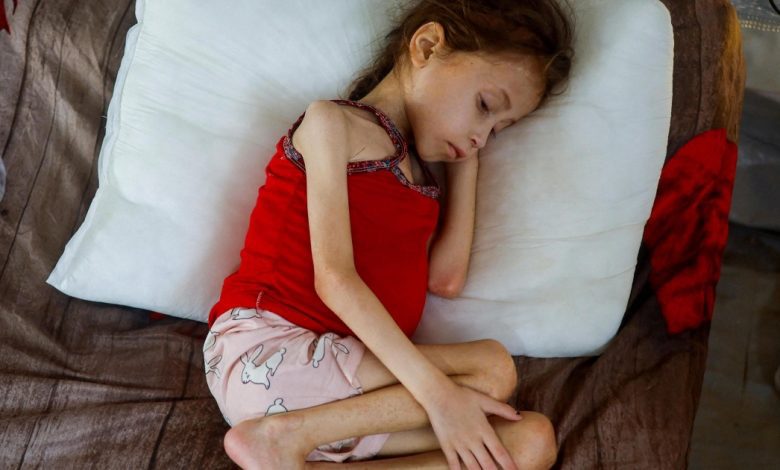 خمس وفيات نتيجة الجوع وسوء التغذية في غزة
