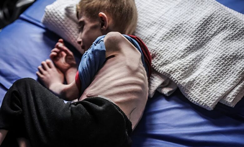 ثلاث حالات وفاة نتيجة المجاعة في غزة