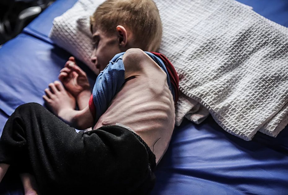 ثلاث حالات وفاة نتيجة المجاعة في غزة
