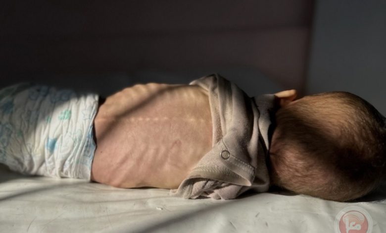 وفاة رضيع نتيجة سوء التغذية بغزة