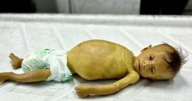وفاة طفل فلسطينى بسبب المجاعة وتضخم فى الكبد