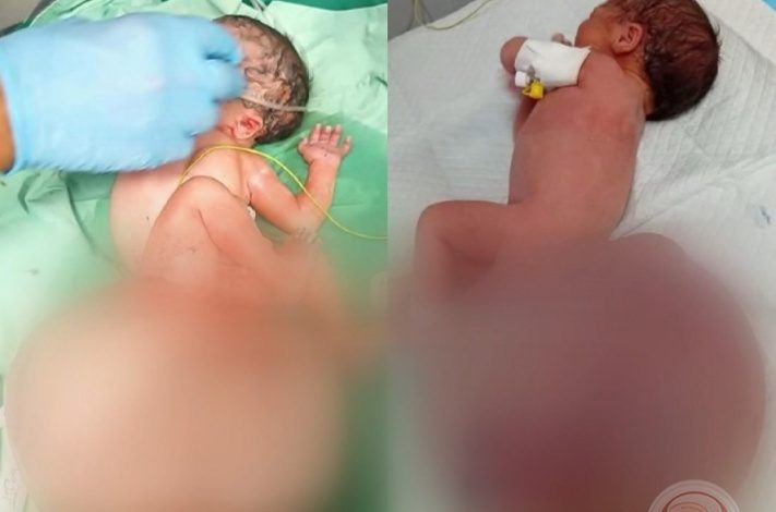 طفلة تولد بورم نادر بغزة