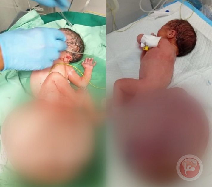 طفلة تولد بورم نادر بغزة