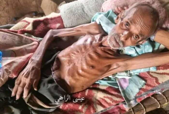 الجوع يواصل الفتك بالنازحين في حجة