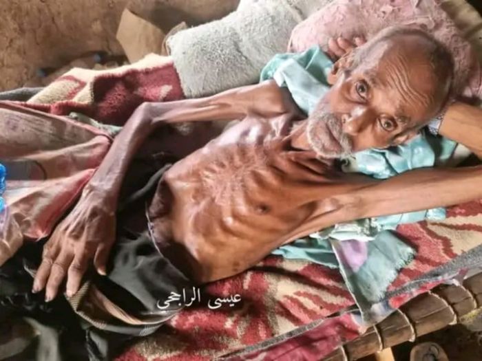 الجوع يواصل الفتك بالنازحين في حجة