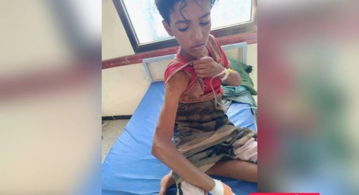 إصابة طفل برصاص قناص حوثي في لحج