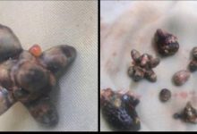 الدكتور ربيع الصبيحي ينجح في أستخراج حصوات من كلية مريض من ابناء ردفان في المستشفى الاردني