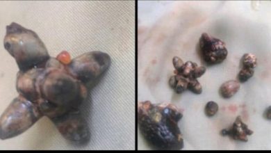 الدكتور ربيع الصبيحي ينجح في أستخراج حصوات من كلية مريض من ابناء ردفان في المستشفى الاردني