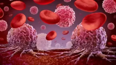 المعهد القومي للأورام في مصر يحذر من علاجات بديلة ترفع خطر الوفاة بمرض السرطان 2.5 مرة