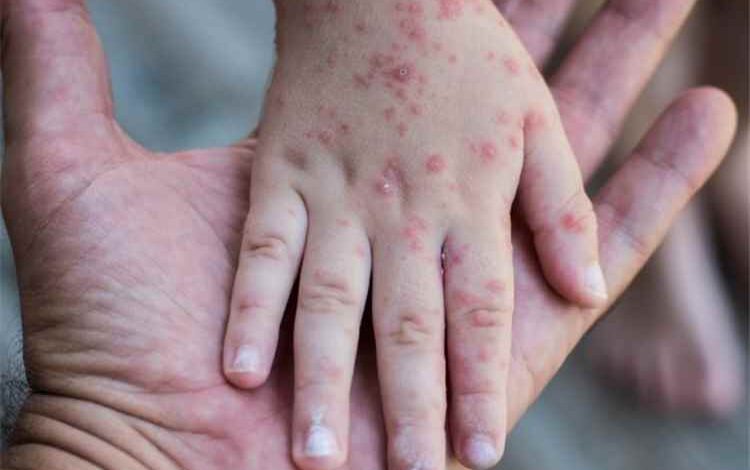 أكثر من 12.8 ألف إصابة بالحصبة و71 وفاة خلال 5 أشهر في اليمن
