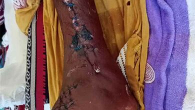 جمعية صيادي أحور تناشد السلطات ورجال الخير لمساندة الصياد حميد العمودي بعد إصابته في حادثة غرق