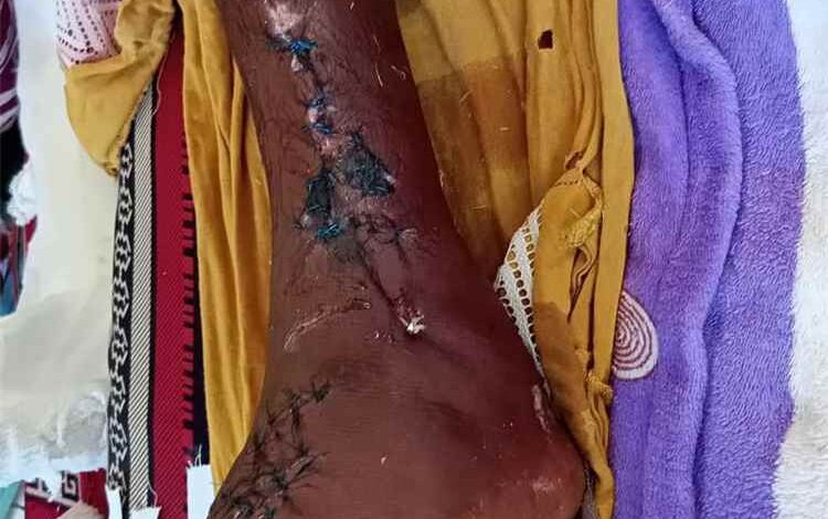 جمعية صيادي أحور تناشد السلطات ورجال الخير لمساندة الصياد حميد العمودي بعد إصابته في حادثة غرق