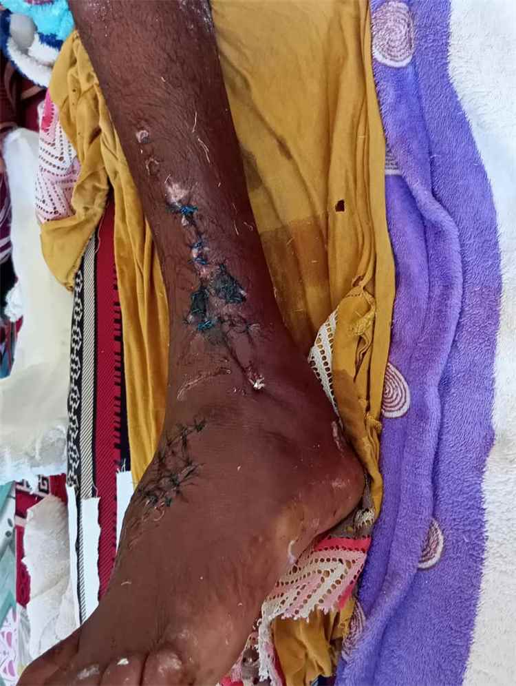 جمعية صيادي أحور تناشد السلطات ورجال الخير لمساندة الصياد حميد العمودي بعد إصابته في حادثة غرق