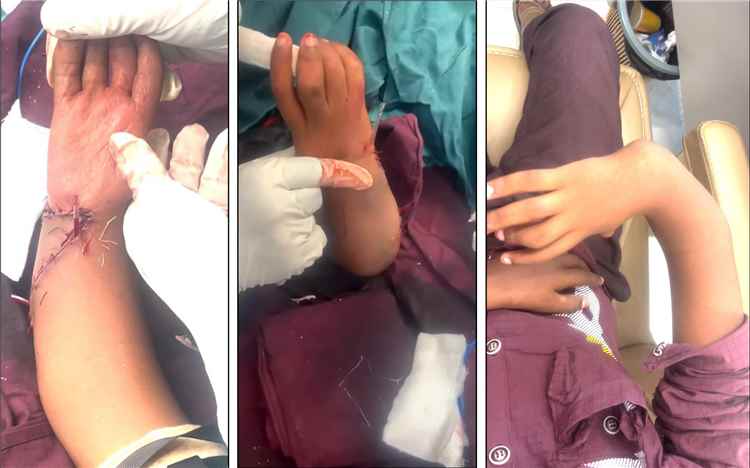 إنجاز طبي غير مسبوق في اليمن.. جراح يمني في عدن ينهي معاناة طفل من تشوه خلقي معقد بعد 13 عاماً من المعاناة