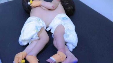 المشهد اليمني - نداء إنساني عاجل لإنقاذ توأم سيامي في صنعاء