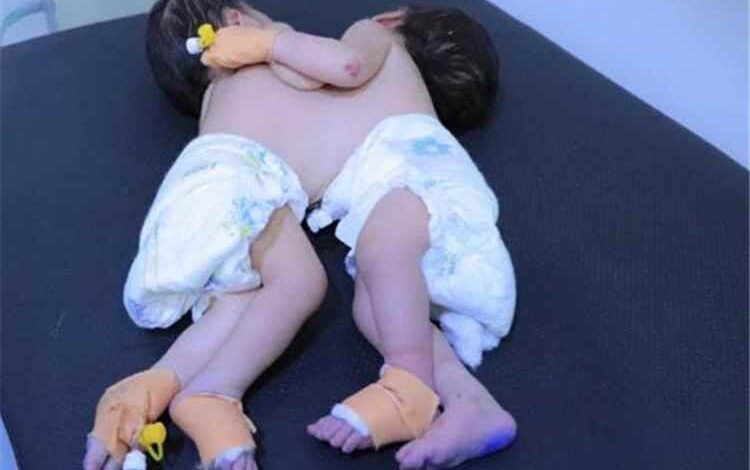 المشهد اليمني - نداء إنساني عاجل لإنقاذ توأم سيامي في صنعاء