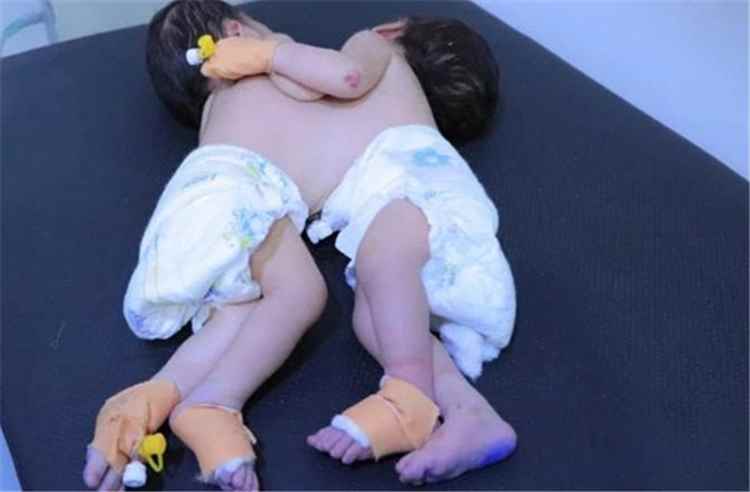 نداء إنساني عاجل لإنقاذ توأم سيامي في صنعاء
