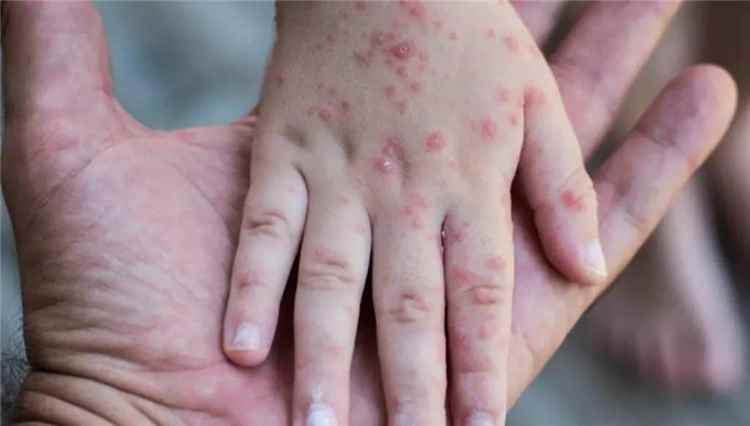 بسبب تفشي الحصبة.. السلطة المحلية بمأرب تعلن حالة الطوارئ الصحية