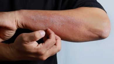 لماذا يزيد تهيج الصدفية صيفًا.. وكيف نتجنبه؟